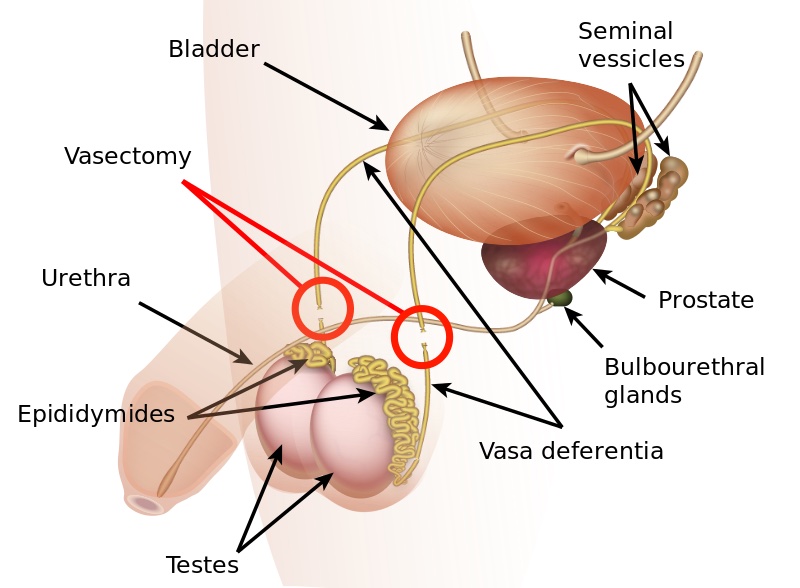 Post-Vasectomy Syndrome