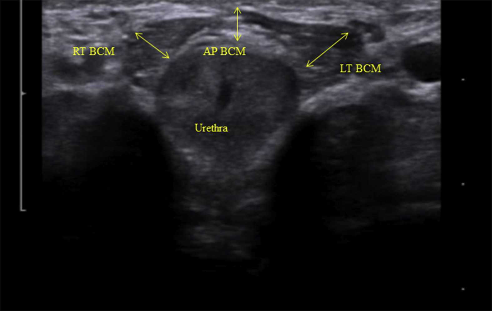 Bulbocavernosus Muscle Ultrasound