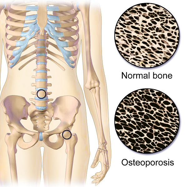 Treating Osteoporosis and Multiple Sclerosis