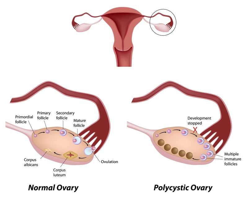 Effects of Exercise on Polycystic Ovary Syndrome