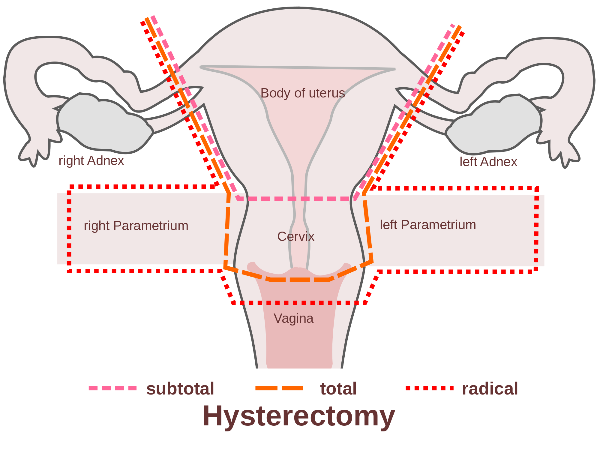 hysterectomy.png