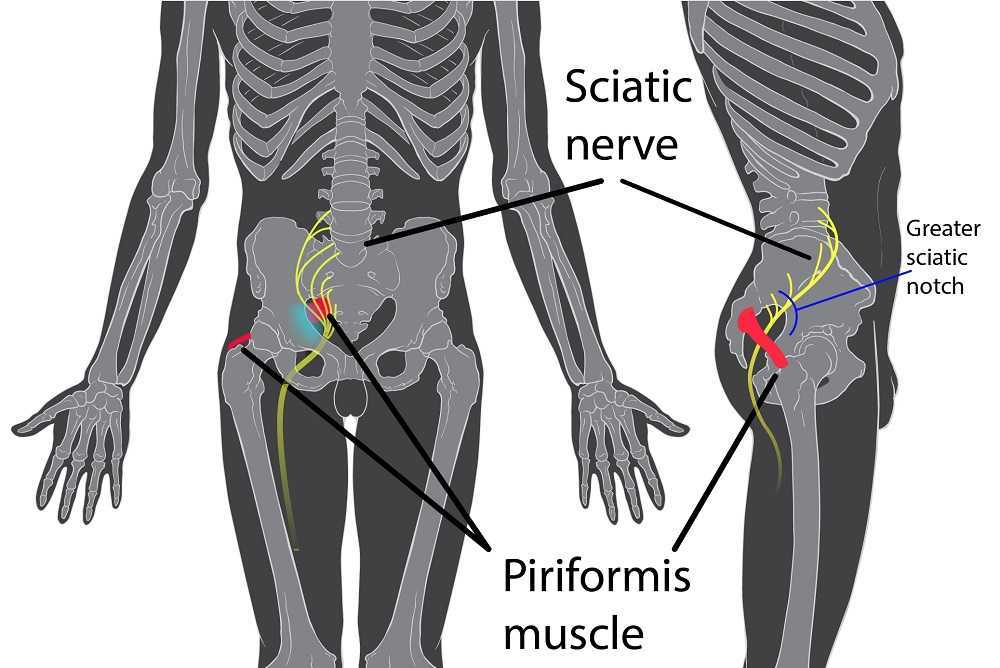 Sciatica nerve compression, Pinched nerve, Sciatic nerve pain