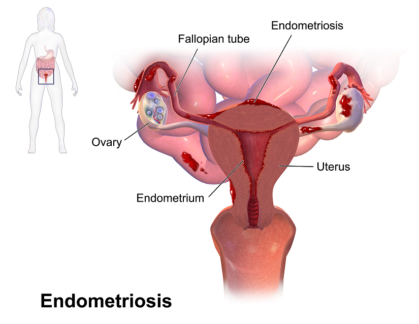 An Updated Look at Endometriosis