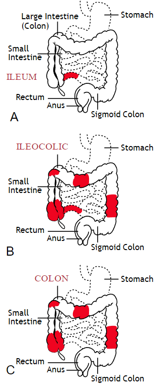 Patterns of Crohns Disease