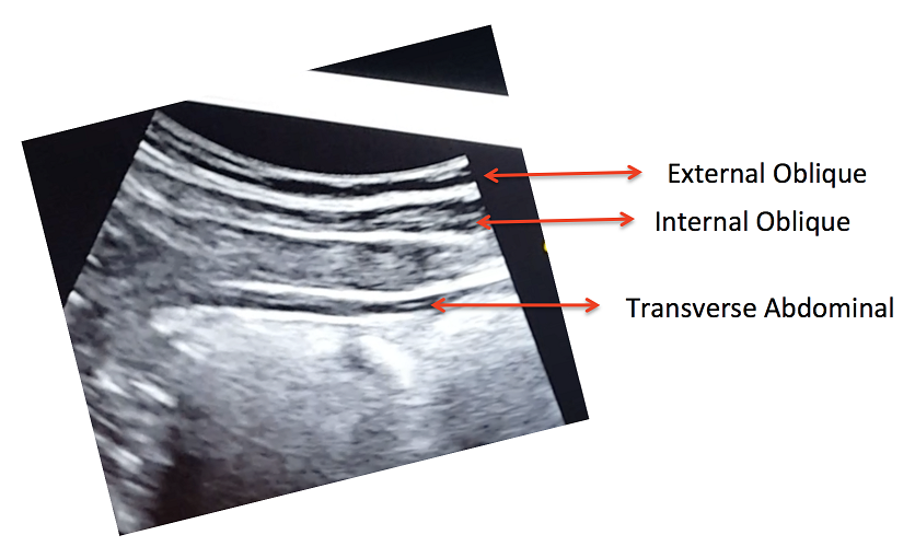 View of the right lateral abdominal wall at rest